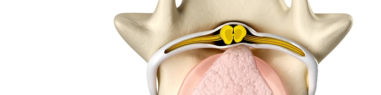 Hernia discal lumbar