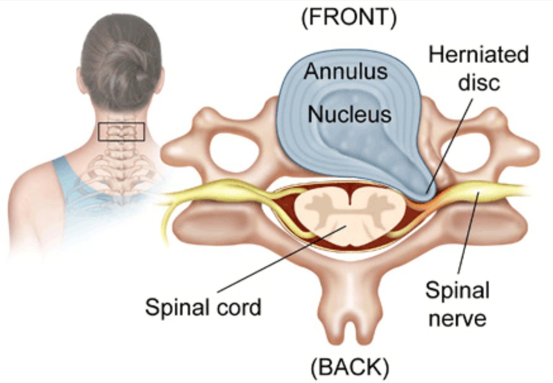 Partes de una hernia discal cervical