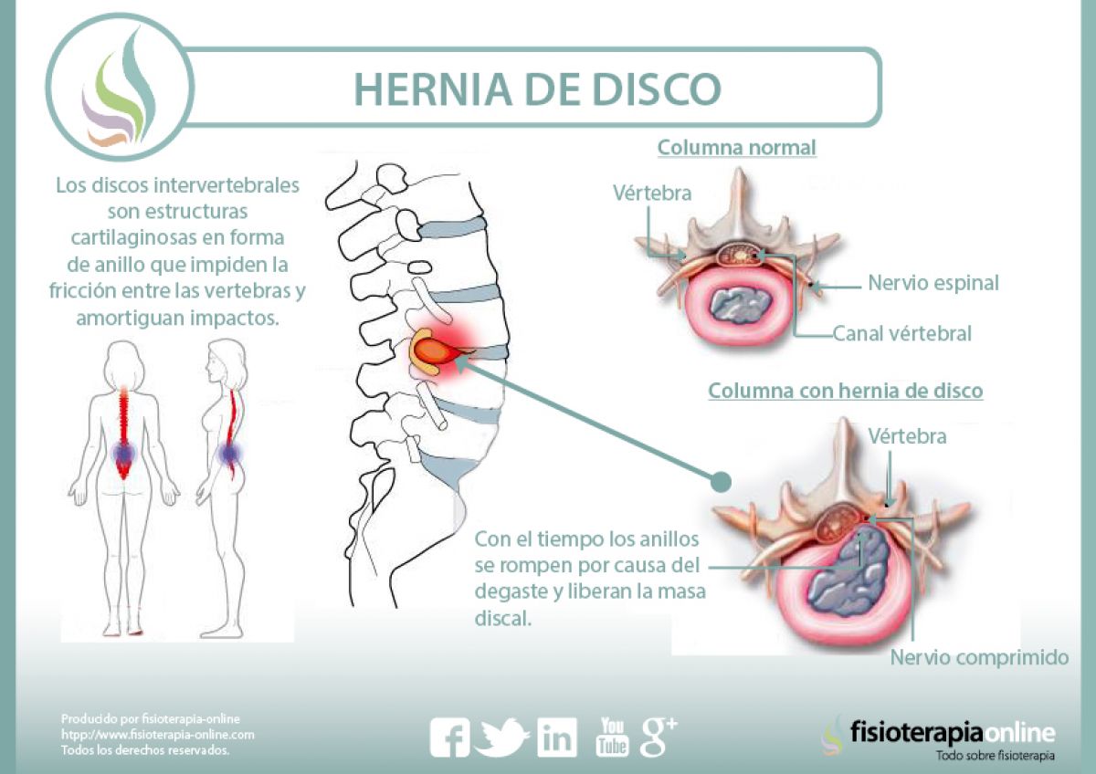 hernia de disco lumbar hernia discal lumbar