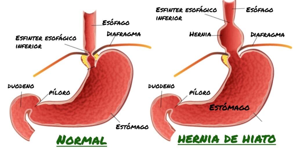 hernia de hiato