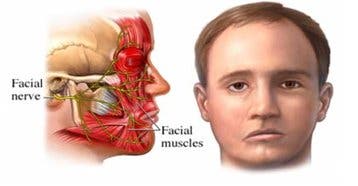 parálisis-facial-diagnóstico-tratamiento-consejos