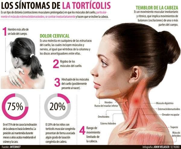 síntomas de la tortícolis