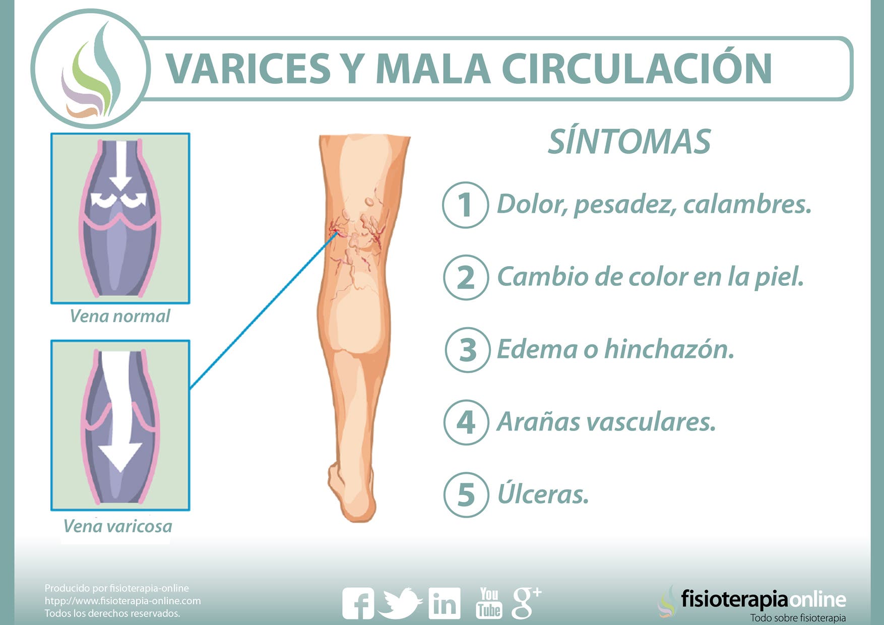 Consejos de tu fisioterapeuta para tratar las varices