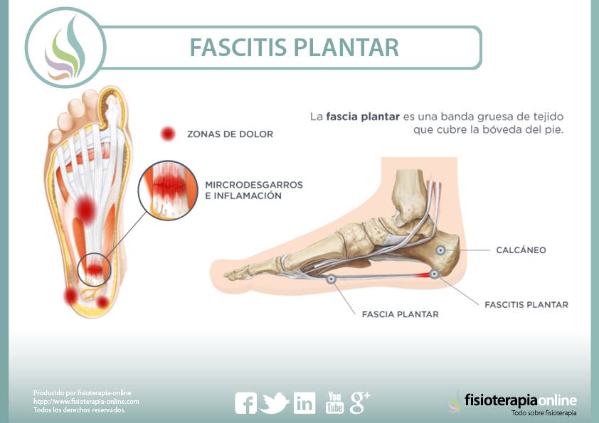 La Fascitis plantar es un padecimiento que ocurre, debido a la