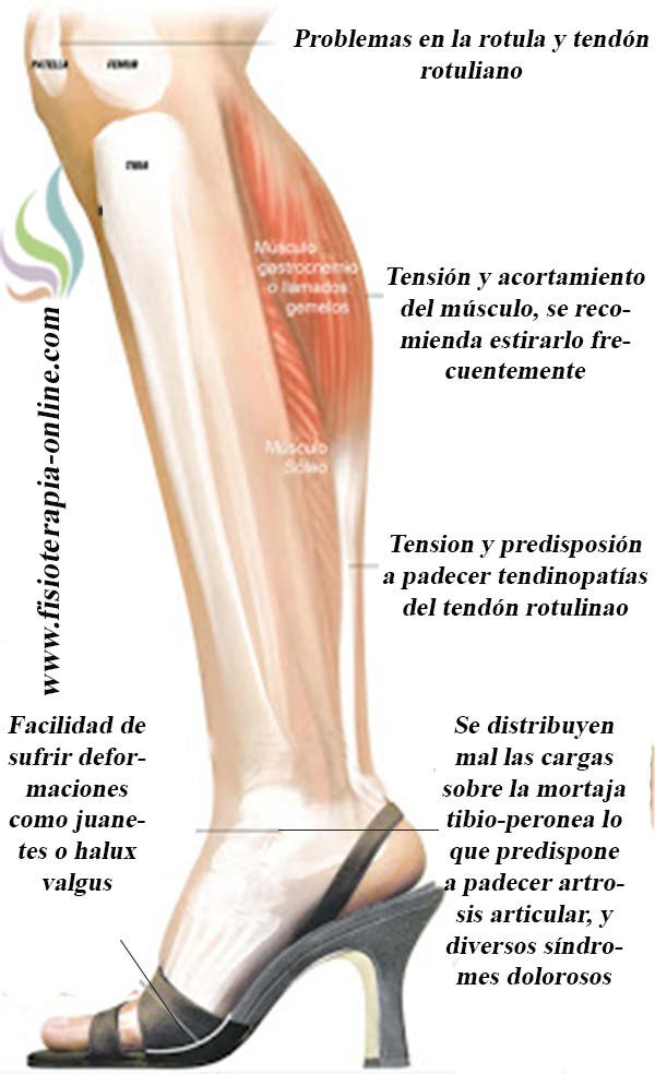 Fascitis plantar, juanetes, neuroma de Morton, conoce las