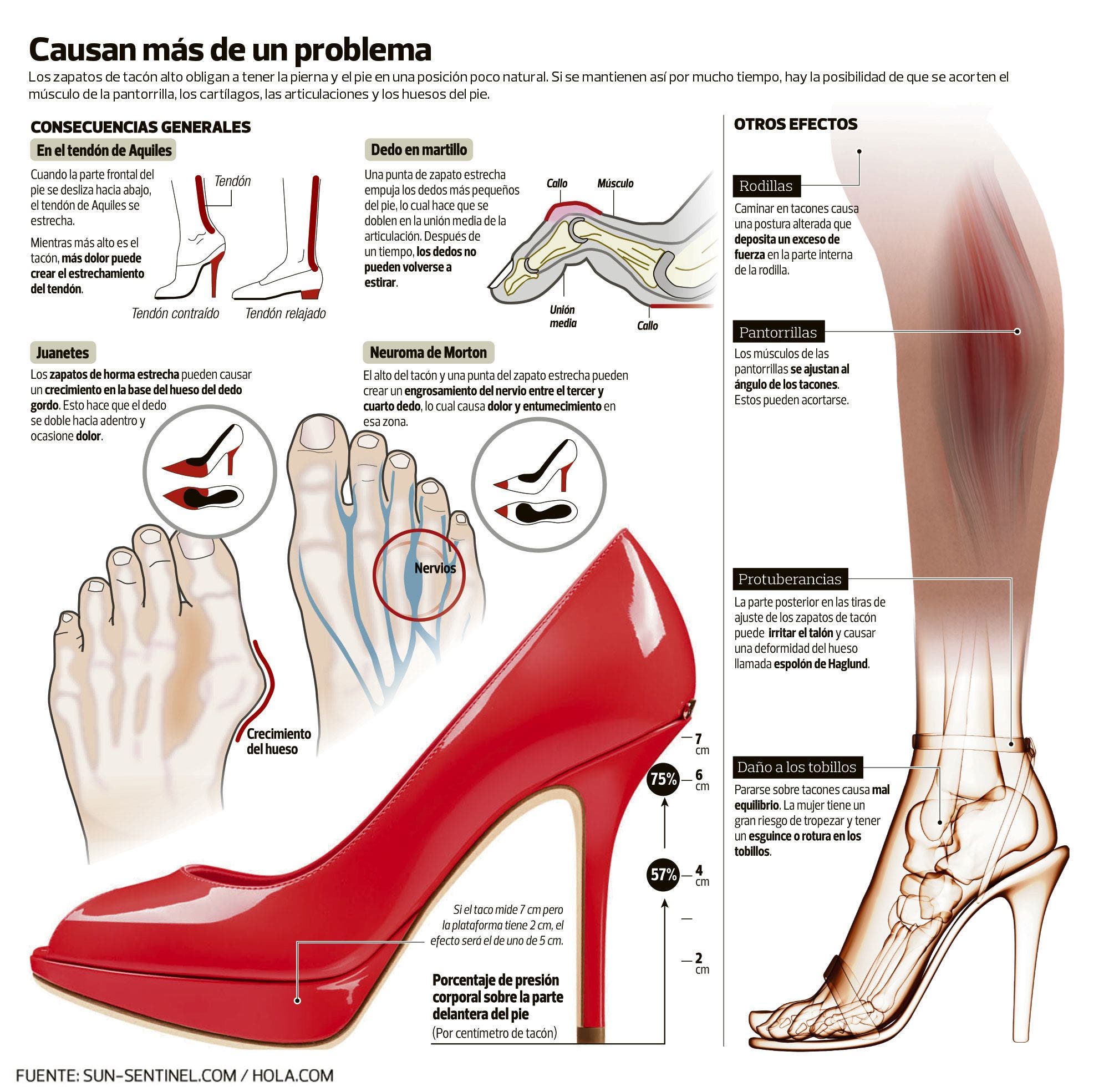 Consecuencias del abuso de tacones. Daños el tendón de Aquiles, juanetes, dedo martillo, neuroma Morton | FisioOnline