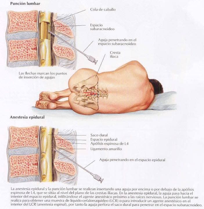 Anestesia epidural, descubre sus indicaciones y sus peligros Fisioterapia Online Anestesia epidural, descubre sus indicaciones y sus peligros Fisioterapia Online