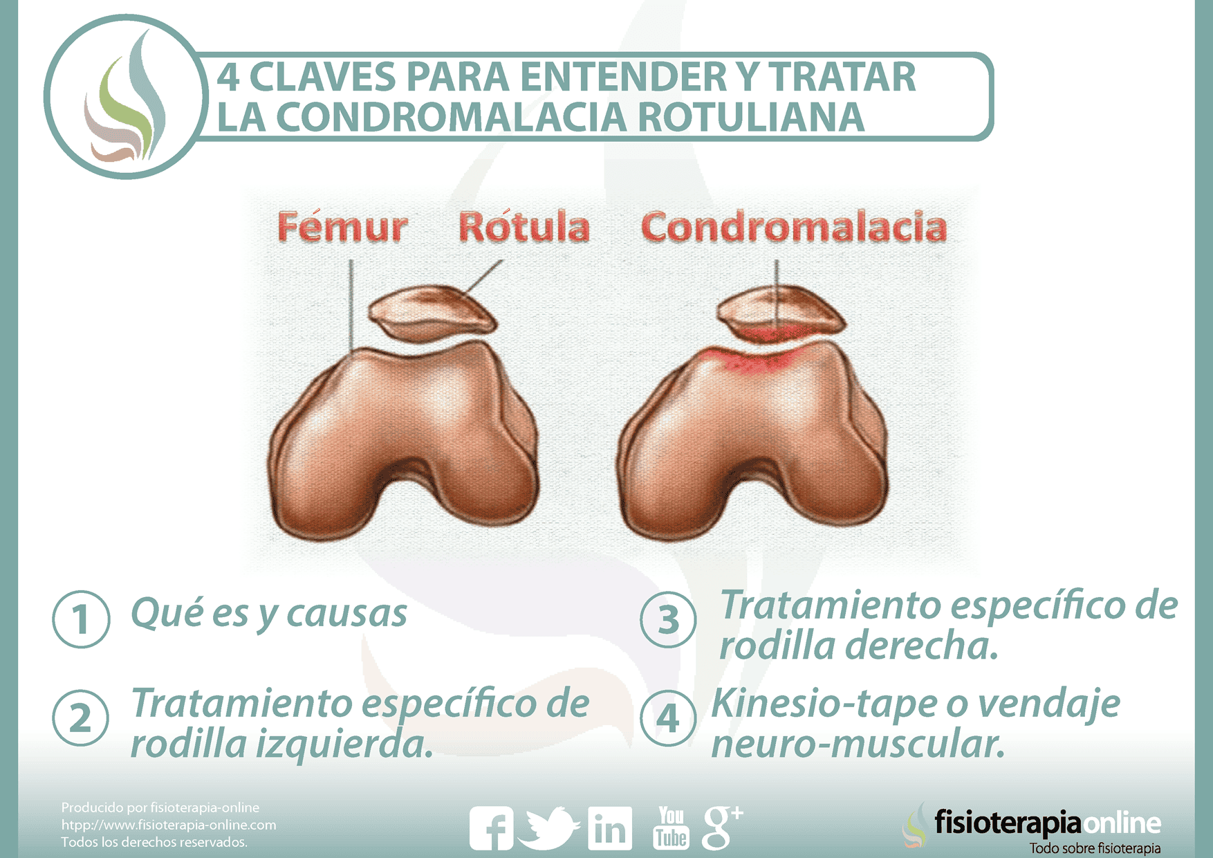 4 Claves Para Entender Y Tratar La Condromalacia Rotuliana Fisioonline