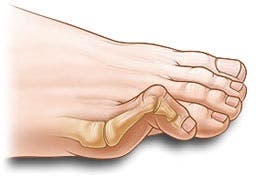 Automasaje de los dedos y zona anterior del pie para ...