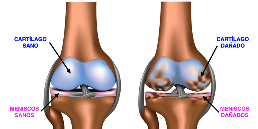Lesión de cartílago