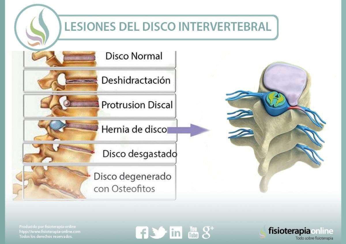lesiones del disco intervertebral
