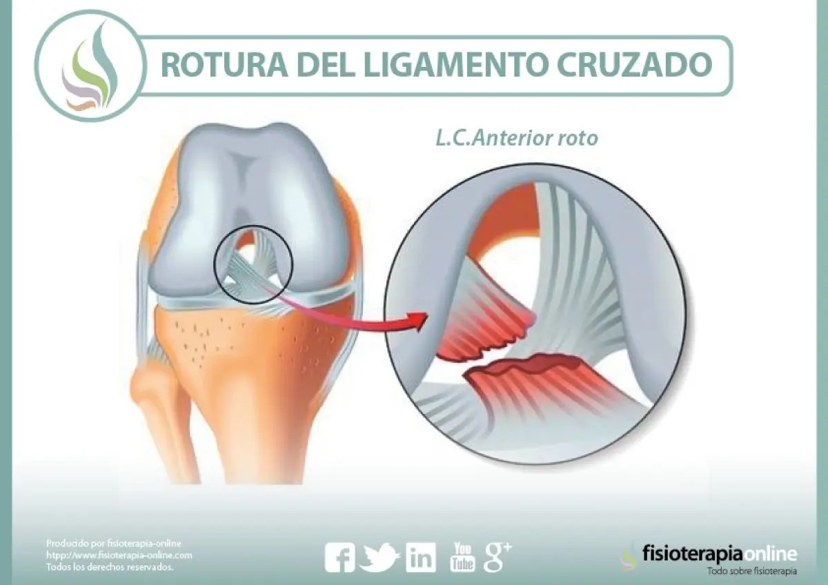 ligamento cruzado anterior ligamento cruzado anterior