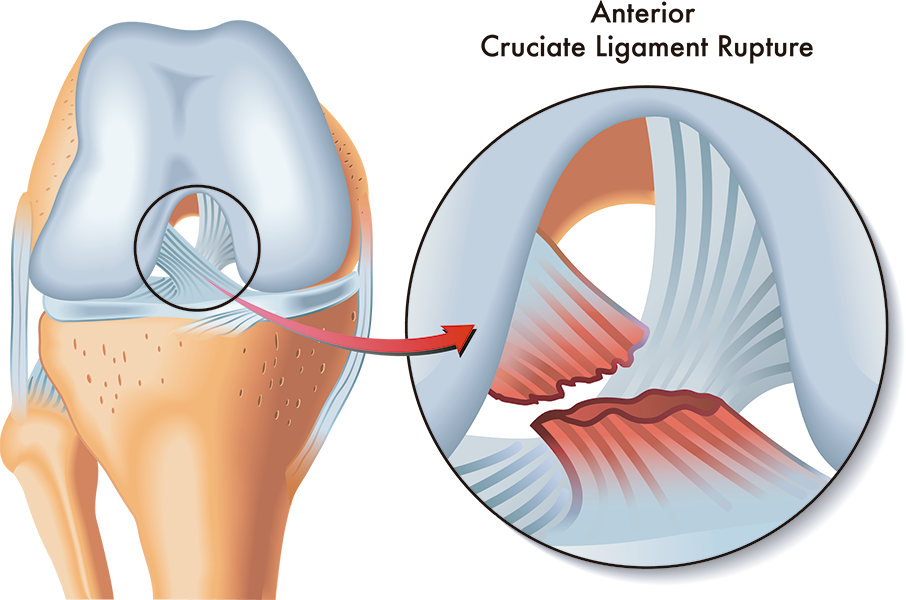 ligamento cruzado anterior