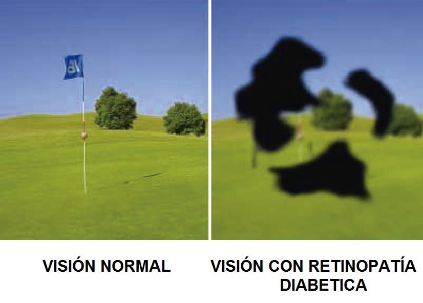 Diabetes y retinipatia diabética