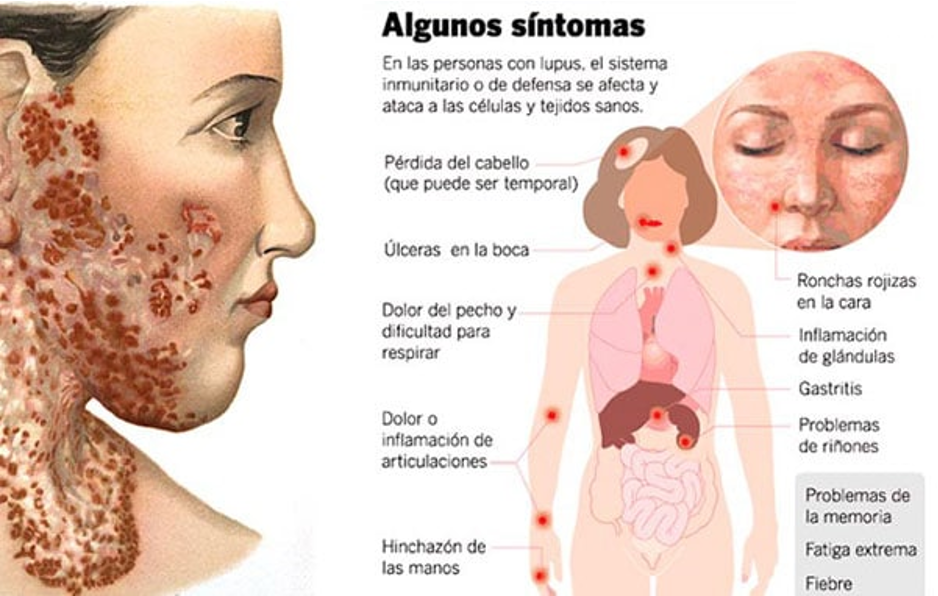 Sintomas del lupus