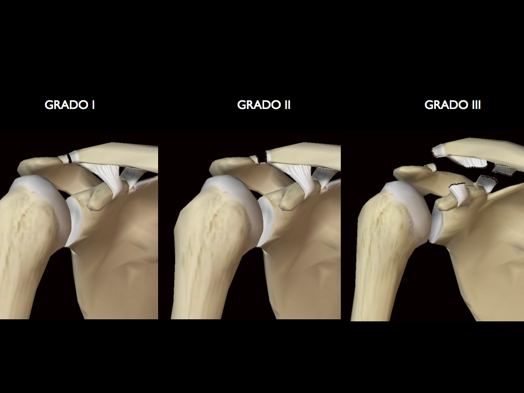 luxación acromioclavicular