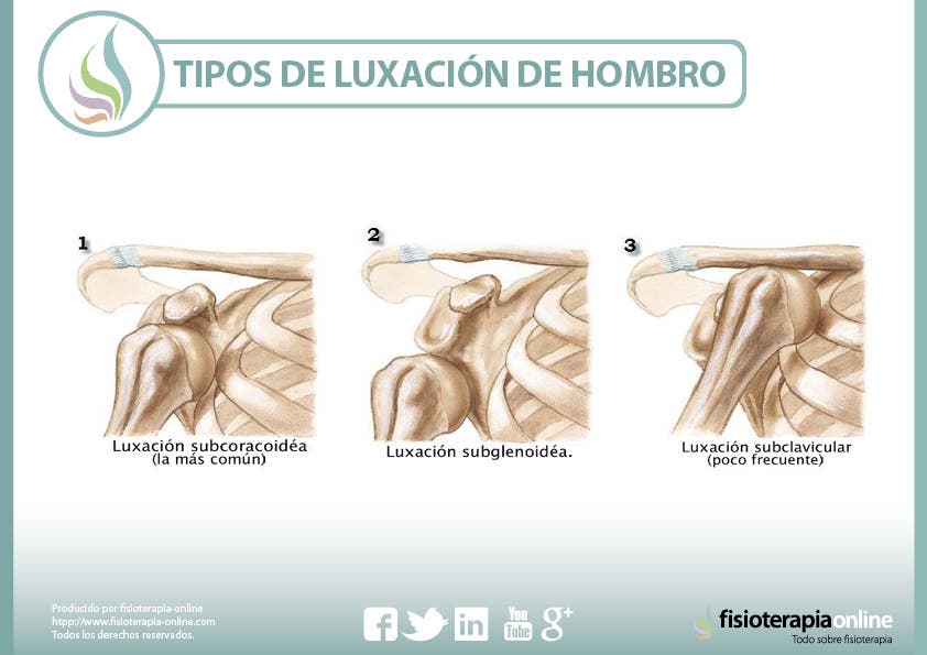 Luxación de hombro tipos 