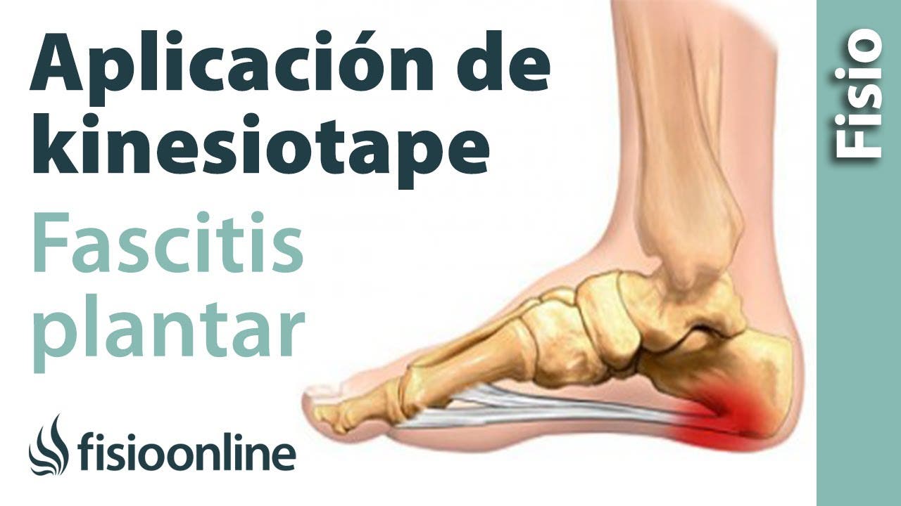 Taping clearance fascitis plantar