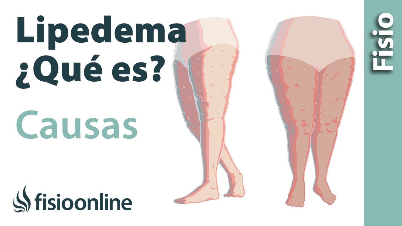 Clínica Angular - El lipedema es una enfermedad crónica y progresiva, que  se caracteriza por una alteración en el metabolismo de las grasas. Es poco  conocida y afecta más a mujeres que