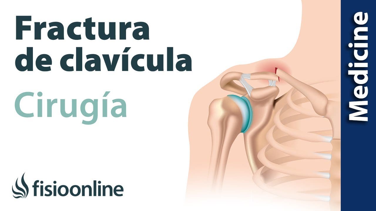 ¿cómo Se Realiza La Operación De La Fractura De Clavícula Fisioonline