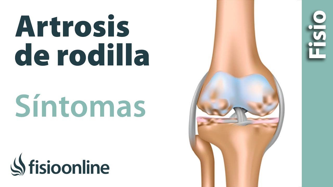 Artrosis de rodilla