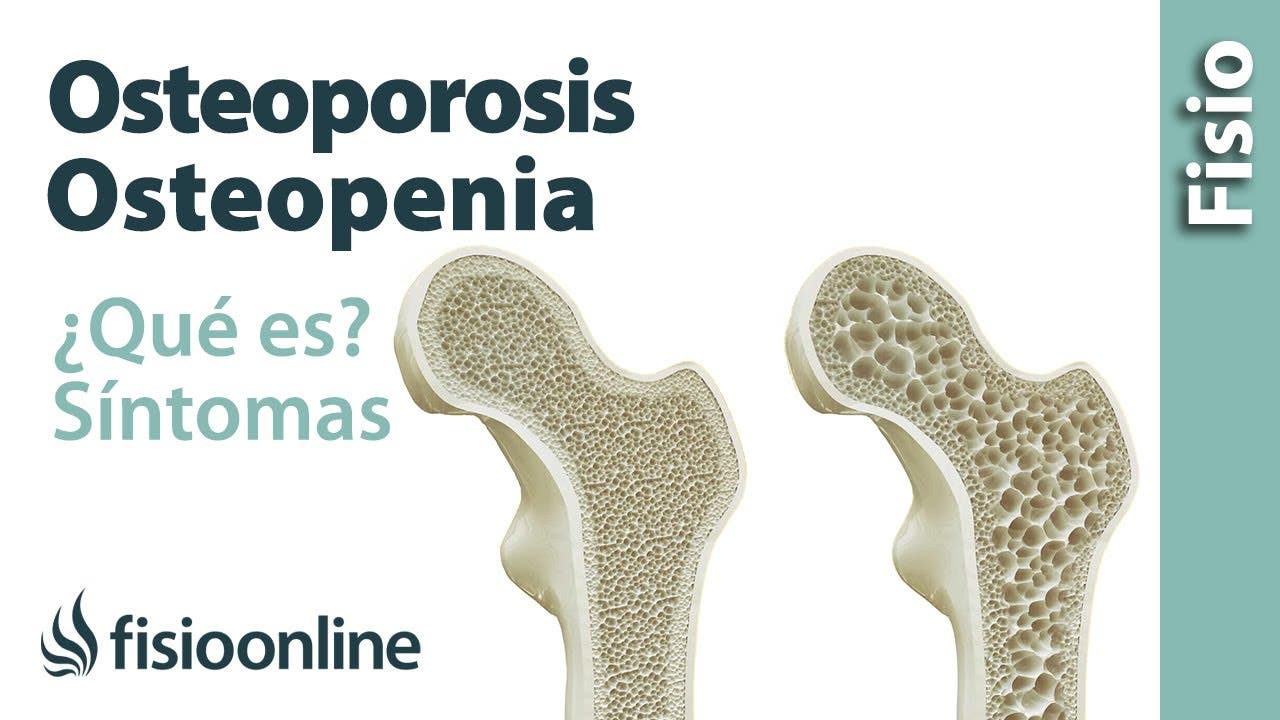 Que alimentos son buenos para la osteoporosis