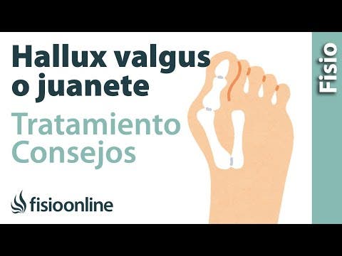 Masajes para eliminar 2025 juanetes