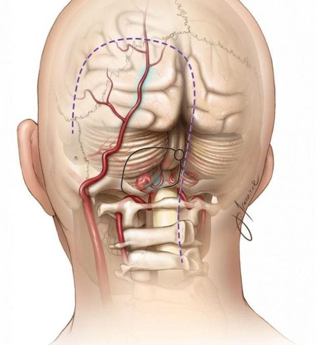 Neuralgia de Arnold 