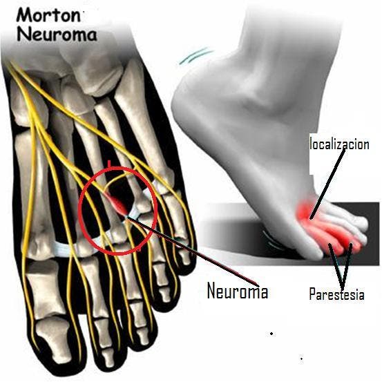 Cómo detectar el neuroma de morton 