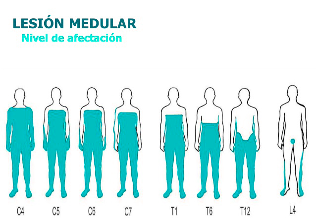 nivel afectacion lesion medular
