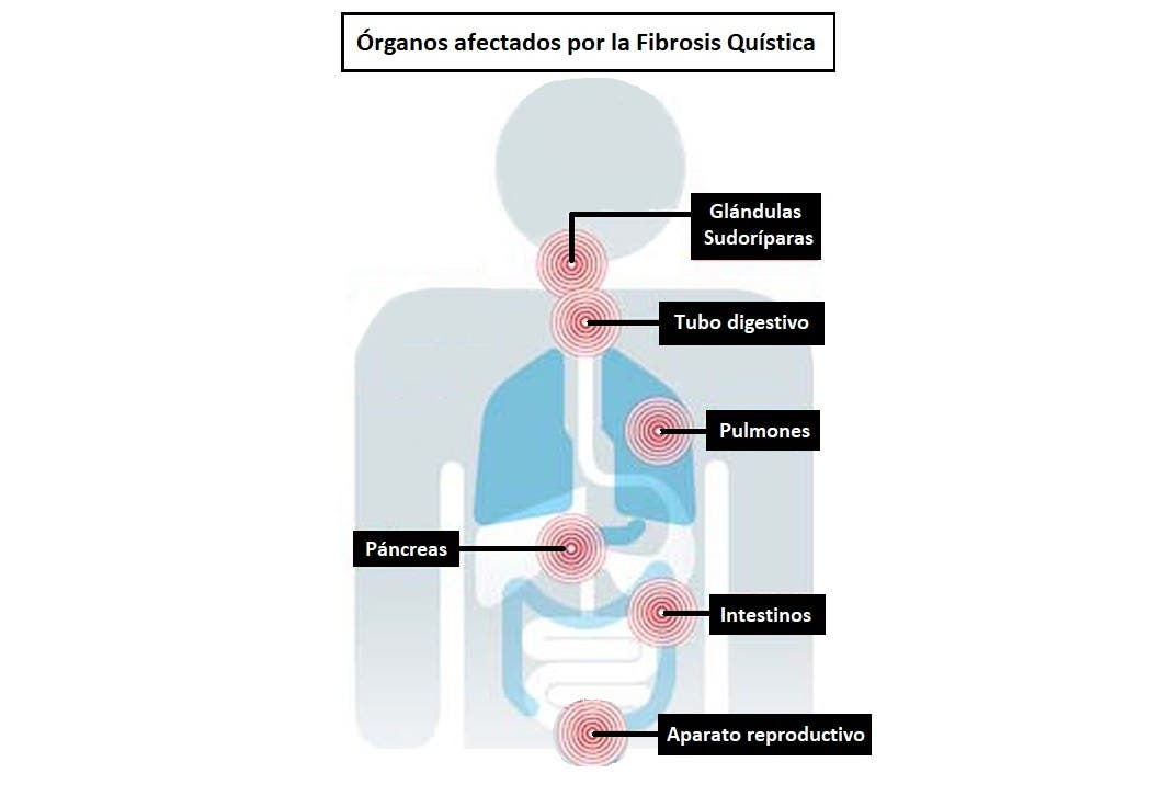 órganos afectados por la fibrosis quístca
