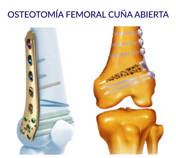 osteotomía femoral