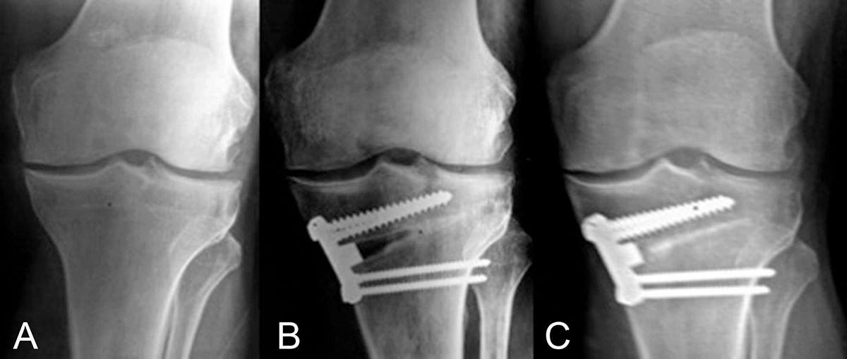 osteotomía tibial