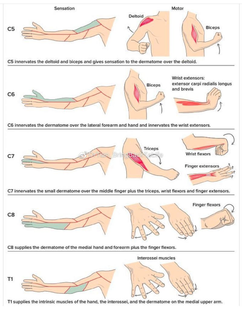 Patrones de los síntomas de la hernia discal cervical