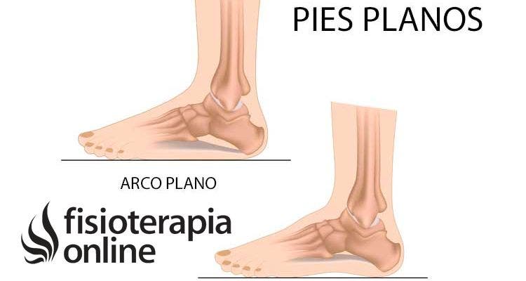 Pie plano como origen de problemas biomecánicos