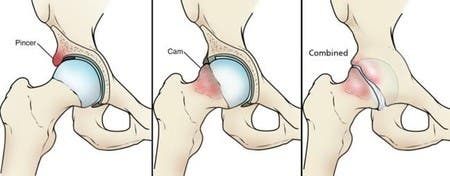 pinzamiento fémoroacetabular 