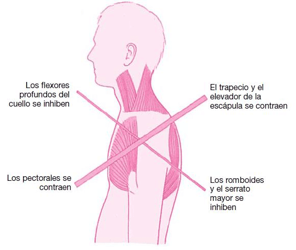 Causas de la postura de Cabeza Adelantada