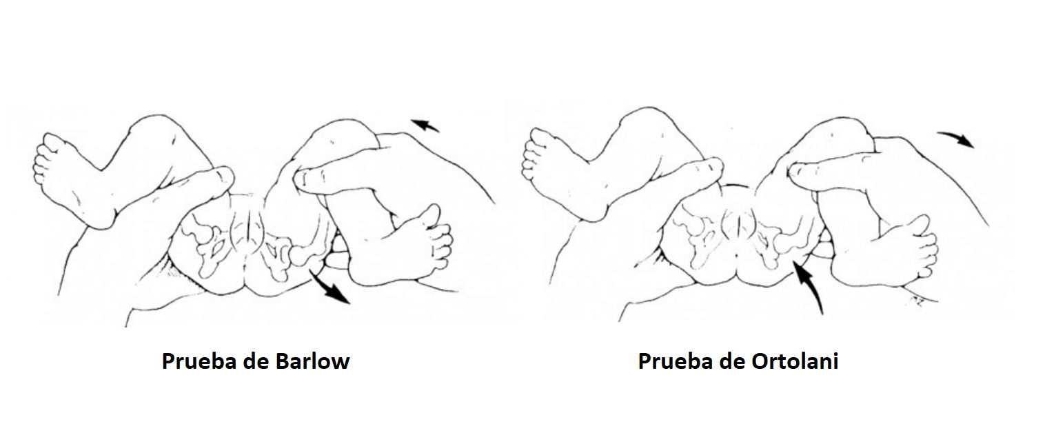 Prueba o maniobra de Ortolani y de Barlow