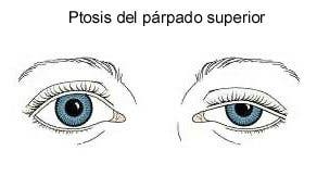 Ptosis parpado superior