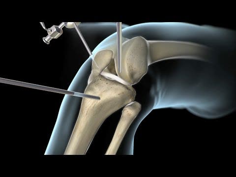 reconstrucción de la rotura del ligamento cruzado anterior (LCA)