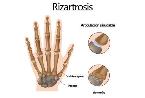 rizartrosis o artrosis del pulgar 