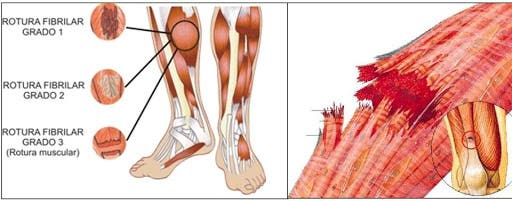 tiempo de recuperación de las roturas de fibras musculares 