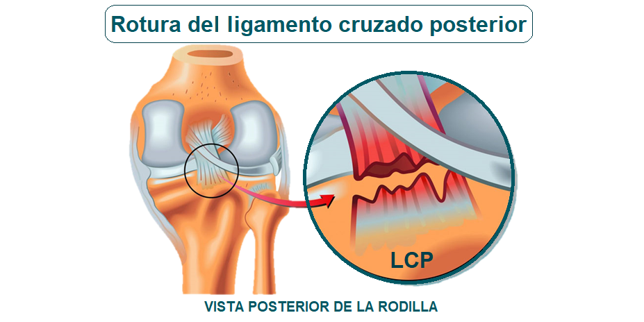 rotura del ligamento cruzado posterior rotura del ligamento cruzado posterior