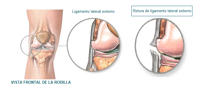 rotura de ligamento lateral externo