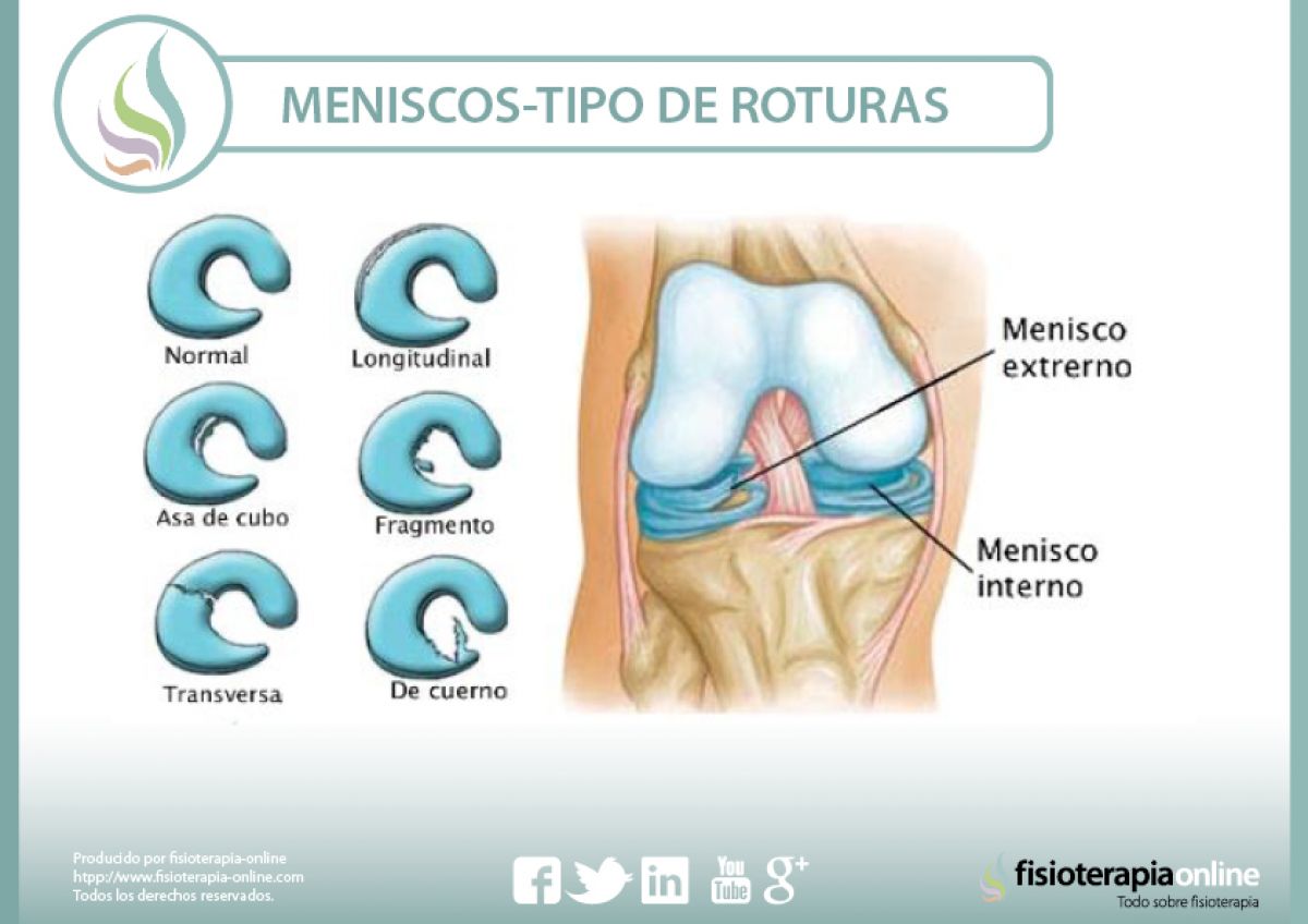 tipos de roturas de meniscos