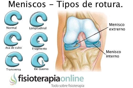 diagnóstico de la rotura de meniscos 