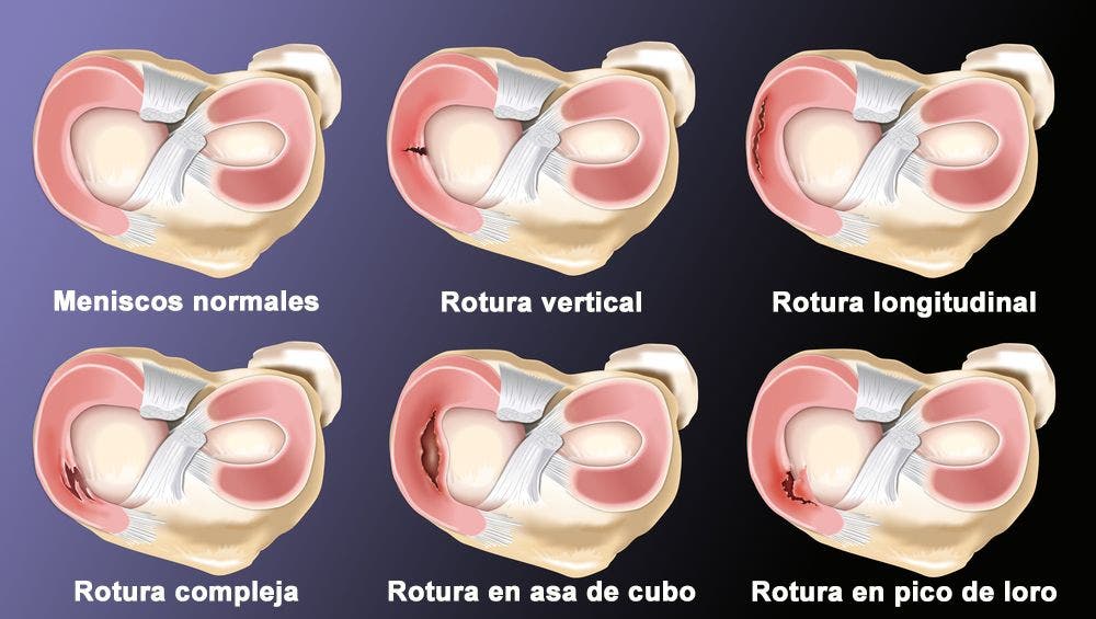 rotura de menisco