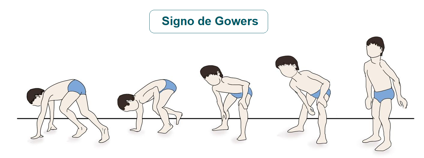 Dificultad para levantarse del suelo (signo de Gowers)