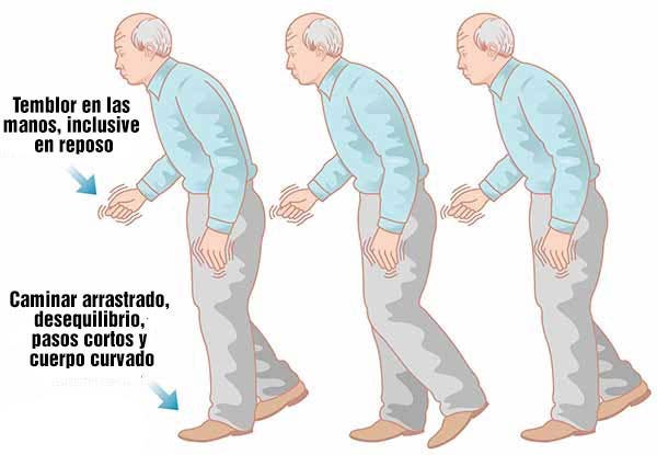 síntomas de la enfermedad de parkinson