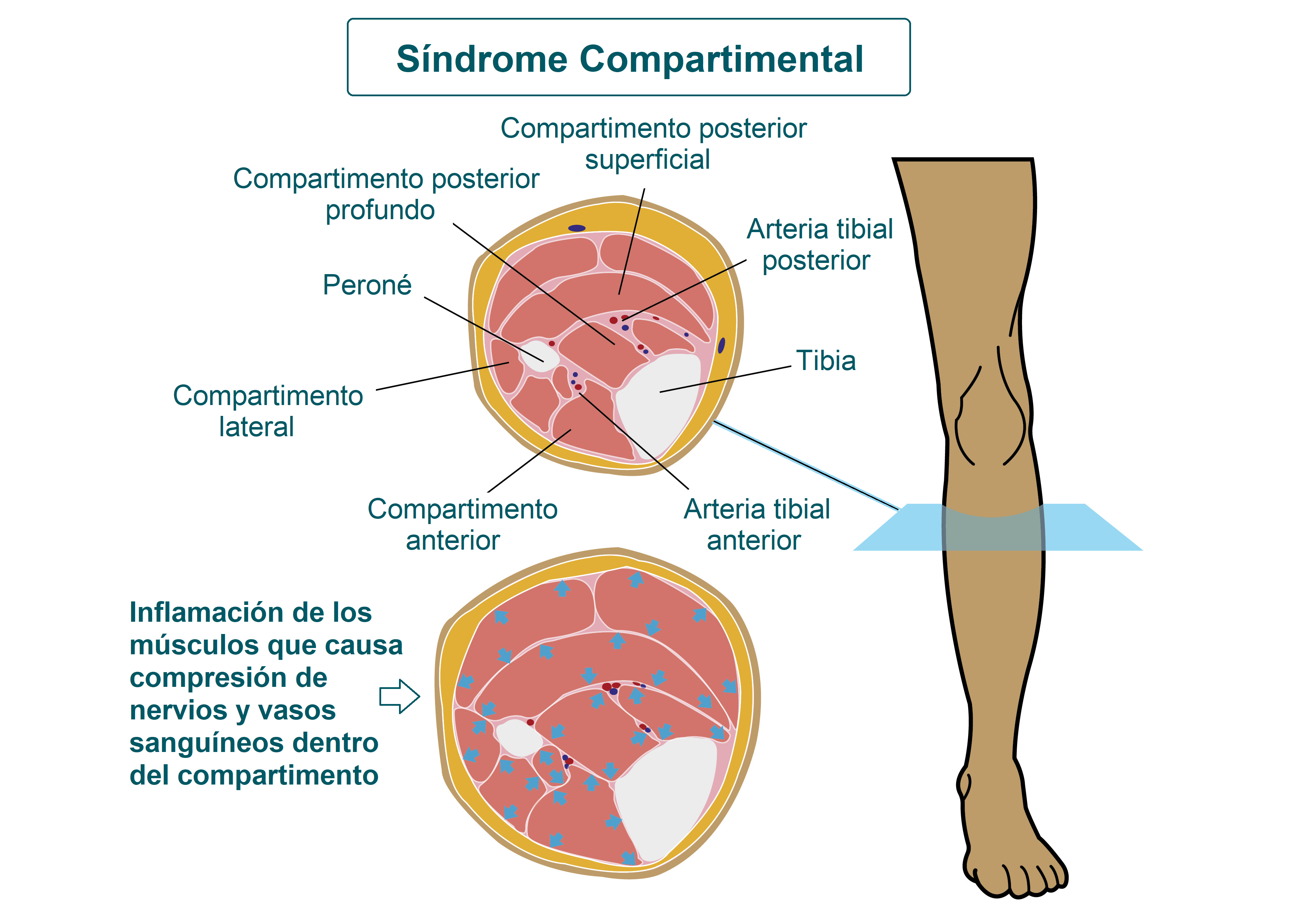 síndrome compartimental